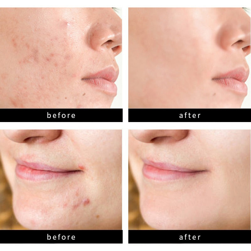 72 Count Acne Scar Patch Spot Stickers Axl