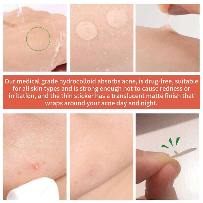 72 Count Acne Scar Patch Spot Stickers Axl