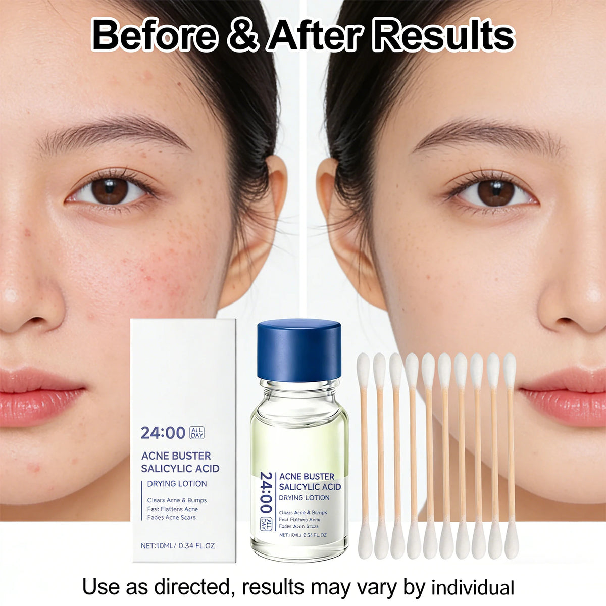Salicylic Acid Drying Lotion – Spot Treatment & Pore Minimizer Acne Spot Treatment Axl