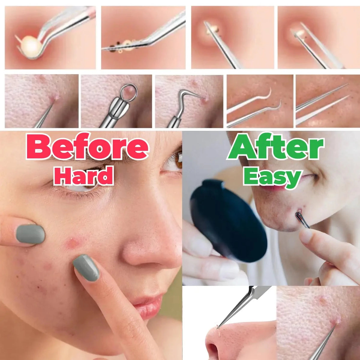 Blackhead Removal Tweezers Set – 2/3 Pcs Stainless Steel Skin Tool Skin Care Tool Set Axl