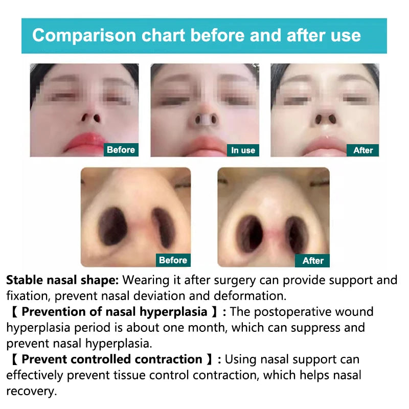 Silicone Nostril Support Clip – Nose Shaping & Breathing Aid Nostril Support Clip Axl