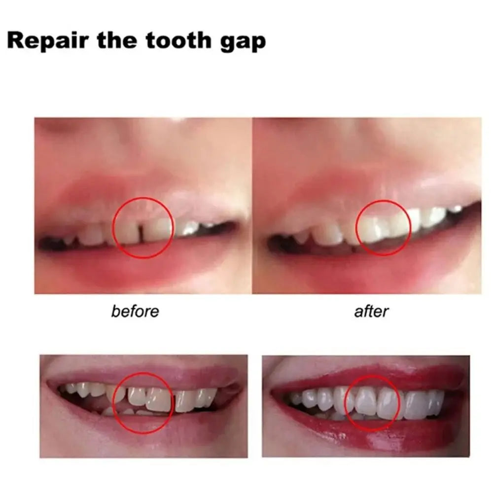 Temporary Tooth Repair Resin Glue – Shapeable Dental Kit Dental Repair Kit Axl