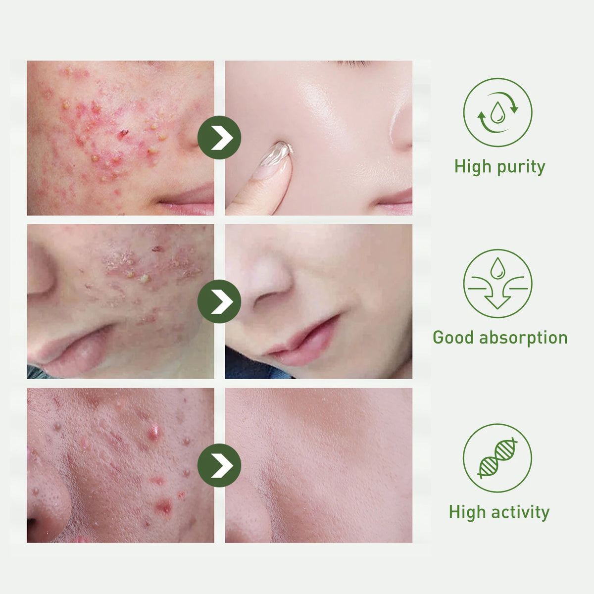 Tea Tree Oil Face Serum – Blemish & Redness Control 30ml Face Serum Axl