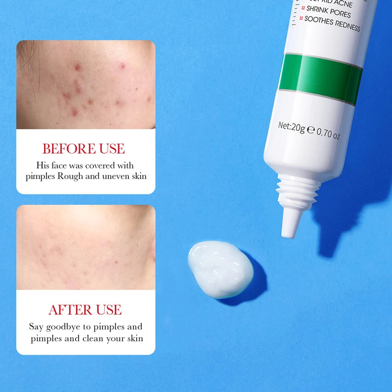 SADOER Salicylic Acid Acne Cream – Blackhead & Pore Care 20g Acne Face Cream Axl