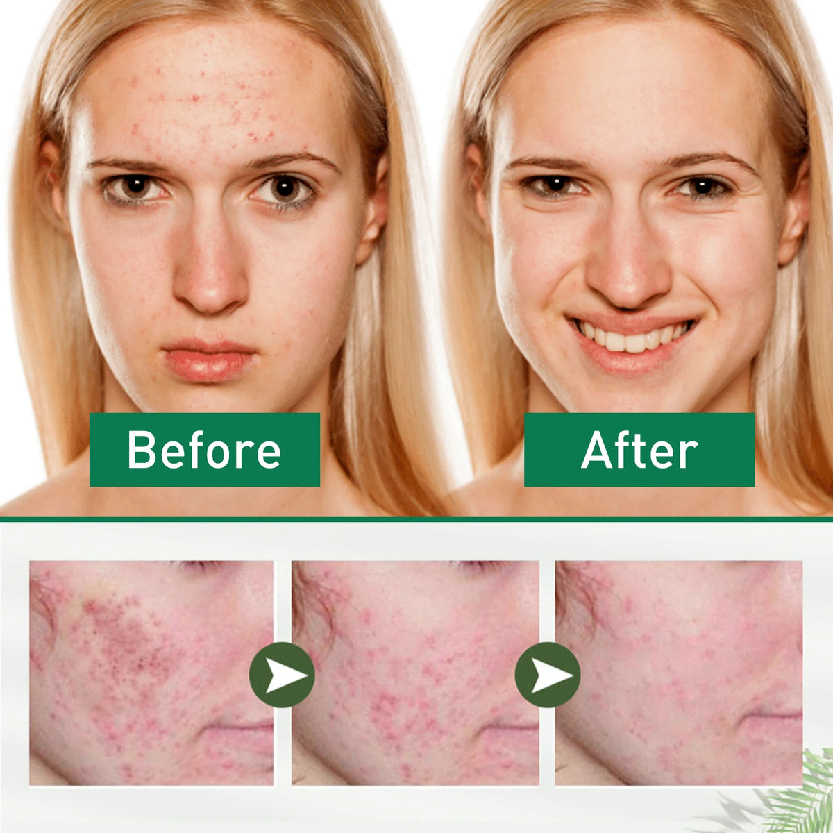 Tea Tree Oil Face Serum – Blemish & Redness Control 30ml Face Serum Axl